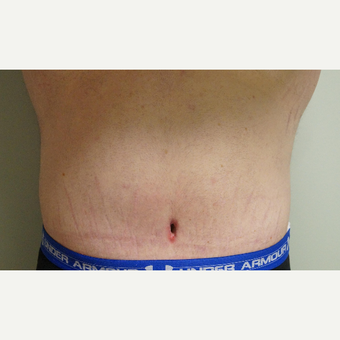 25-34 year old man treated with Body Lift after 3076259