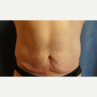 25-34 year old man treated with Body Lift before 3076259