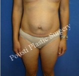 35-44 year old woman treated with Tummy Tuck before 3727432