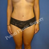 35-44 year old woman treated with Tummy Tuck after 3727432