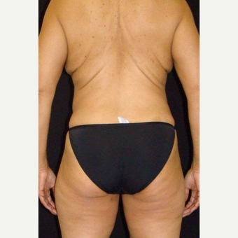 Female treated with CoolSculpting after 3744241