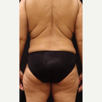 Female treated with CoolSculpting before 3744241