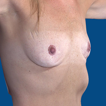 45-54 year old woman treated with Breast Augmentation before 3808702