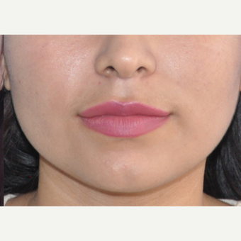 18-24 year old woman treated with Lip Augmentation after 3219587