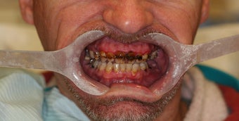 32 year old male treated with All-on-4 Dental Implant Procedure before 1053445