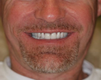 32 year old male treated with All-on-4 Dental Implant Procedure after 1053445