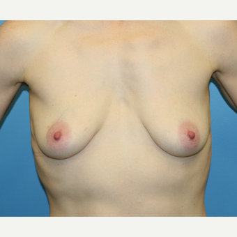 38 year old woman treated with Breast Augmentation before 3486921