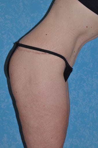 Circumferential Body Lift - Front View 962042