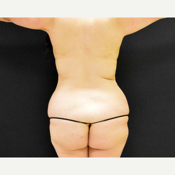 35-44 year old woman treated with Liposculpture before 3201398