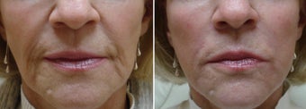Sculptra before 1214297