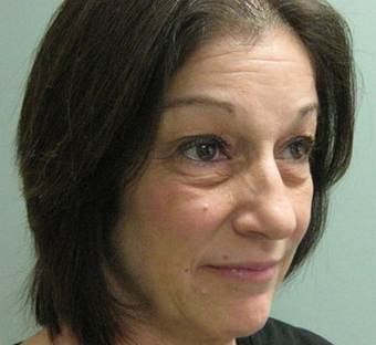 quadbleph "eyelid lift" with midface lift, botox and juvederm to forehead before 266411