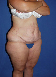 Thigh Lift before 1558001