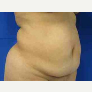 Body Lift before 3100156