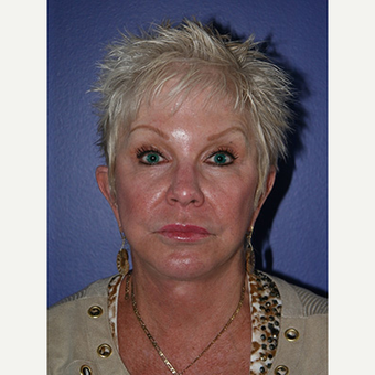59 year old woman treated with Facelift after 3710769