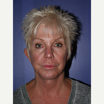 59 year old woman treated with Facelift before 3710769