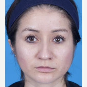 25-34 year old woman treated with Rhinoplasty before 3159509