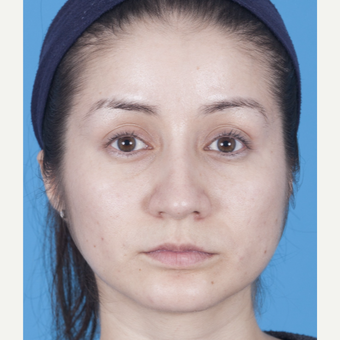 25-34 year old woman treated with Rhinoplasty after 3159509