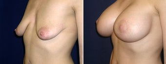 Breast Lift after 996865