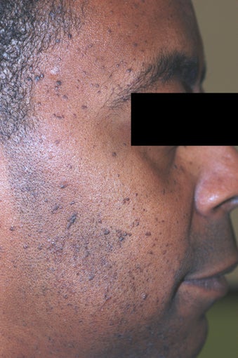 Mole Removal - Dermatosis Papulosa Nigra before 542716