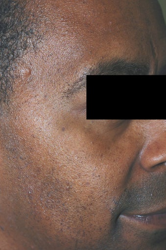 Mole Removal - Dermatosis Papulosa Nigra after 542716