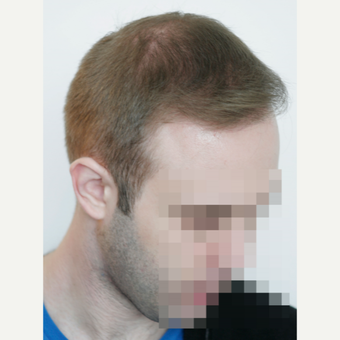 25-34 year old man treated with FUE Hair Transplant after 3682620