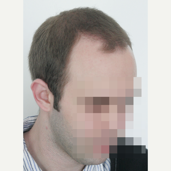 25-34 year old man treated with FUE Hair Transplant before 3682620