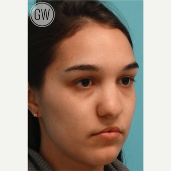 18-24 year old woman treated with Revision Rhinoplasty - Cleft rhinoplasty and lip fat grafting before 3473495