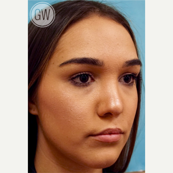 18-24 year old woman treated with Revision Rhinoplasty - Cleft rhinoplasty and lip fat grafting after 3473495