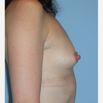 44 year old woman who went form A to B cup with 275 cc saline filled to 299 cc. Moderate profile before 3312852