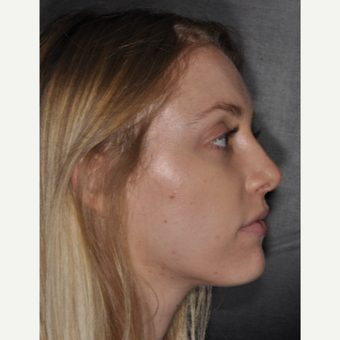 18-24 year old woman treated with Septoplasty 1 year post-op after 3499809