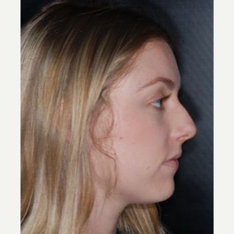18-24 year old woman treated with Septoplasty 1 year post-op before 3499809