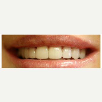 25-34 year old woman treated with Porcelain Veneers after 3411358
