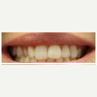 25-34 year old woman treated with Porcelain Veneers before 3411358