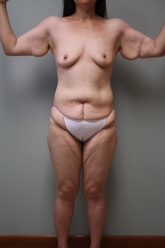 39 year old lady treated for post massive weight loss excess skin before 1515403