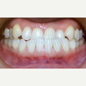 25-34 year old woman treated with Braces before 2242930