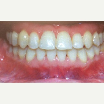 25-34 year old woman treated with Braces after 2242930