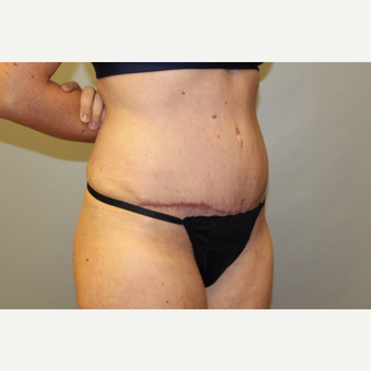 25-34 year old woman treated with Tummy Tuck after 3529277