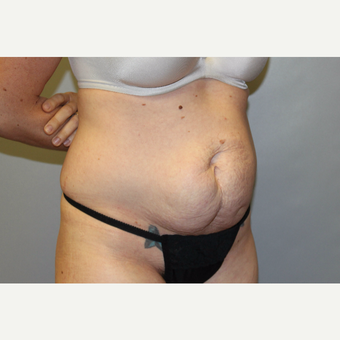 25-34 year old woman treated with Tummy Tuck before 3529277