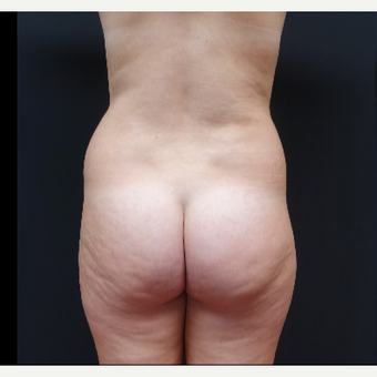 18-24 year old woman treated with Butt Augmentation before 3315482