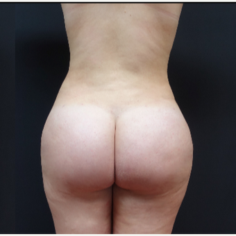 18-24 year old woman treated with Butt Augmentation after 3315482