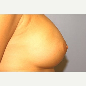 44 year old woman with long nipples treated with nipple reduction after 1536664