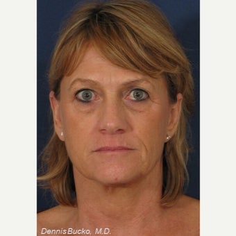 45-54 year old woman treated with Wrinkle Treatment before 2249123