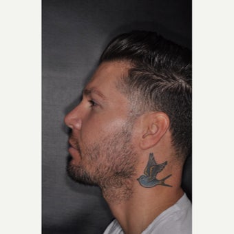 25-34 year old man treated with Buccal Fat Removal after 2251443