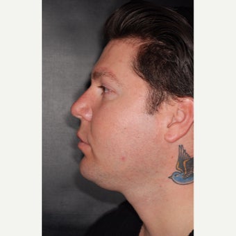 25-34 year old man treated with Buccal Fat Removal before 2251443