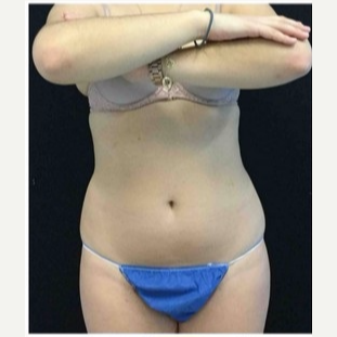 18-24 year old woman treated with CoolSculpting before 3181788