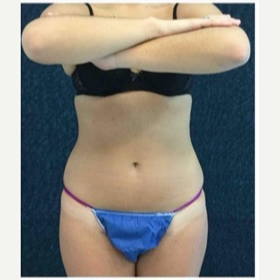 18-24 year old woman treated with CoolSculpting after 3181788
