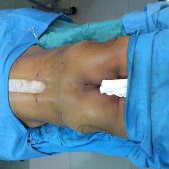45-54 year old woman treated with Brazilian Butt Lift before 2141914