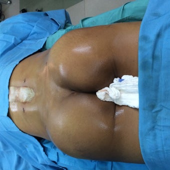 45-54 year old woman treated with Brazilian Butt Lift after 2141914