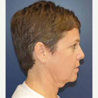 55-64 year old woman treated with Mini Lift before 3461032