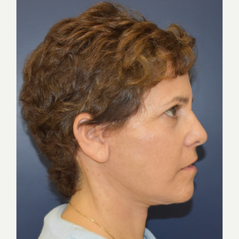 55-64 year old woman treated with Mini Lift after 3461032